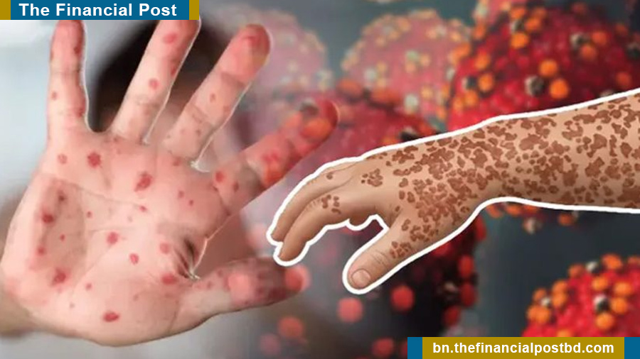 হাম ও হামের উপসর্গে ২৪ ঘণ্টায় আরও ১০ শিশুর মৃত্যু