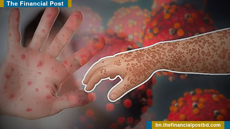 হাম ও হামের উপসর্গে আরও ৮ শিশুর মৃত্যু