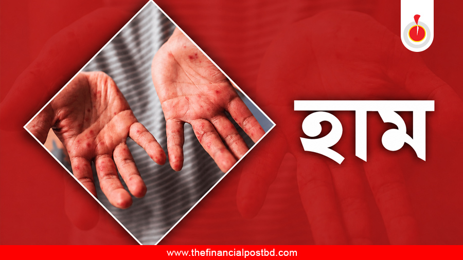 হাম উপসর্গ নিয়ে প্রাণ গেল ৫ জনের