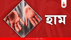 হামের উপসর্গে আরও ৬ মৃত্যু, প্রাণহানি বেড়ে ৯০৮